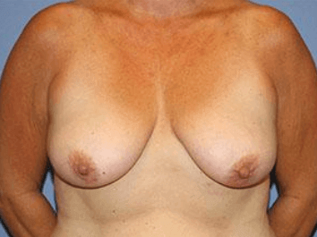 Breast Lift Before & After Patient #6836