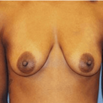 Breast Lift Before & After Patient #6842