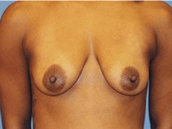Breast Lift Before & After Patient #6842