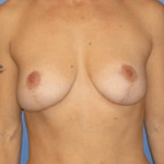 Breast Lift Before & After Patient #6841