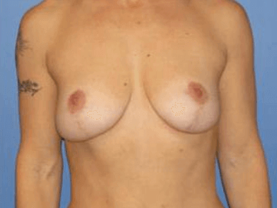 Breast Lift Before & After Patient #6841