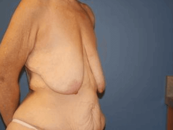 Breast Lift Before & After Patient #6867