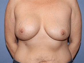 Breast Revision Before & After Patient #7165