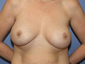 Breast Revision Before & After Patient #7239