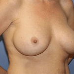 Breast Revision Before & After Patient #7239