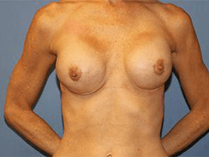 Breast Revision Before & After Patient #7337