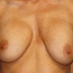 Breast Revision Before & After Patient #7447