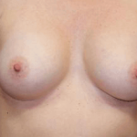 Breast Revision Before & After Patient #7446