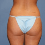 Liposuction Before & After Patient #5864