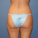 Liposuction Before & After Patient #5864