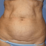 Liposuction Before & After Patient #5868