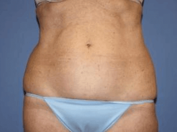 Liposuction Before & After Patient #5868
