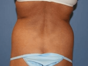 Liposuction Before & After Patient #5869