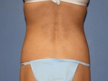 Liposuction Before & After Patient #5869