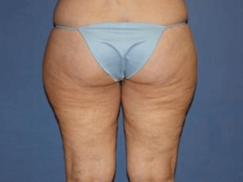 Liposuction Before & After Patient #5870