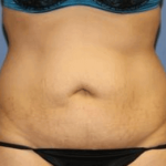 Liposuction Before & After Patient #5871