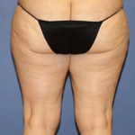 Liposuction Before & After Patient #5872