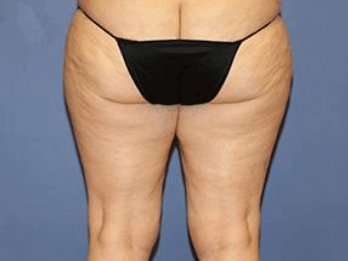 Liposuction Before & After Patient #5872