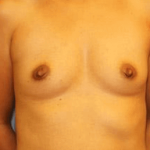 Breast Augmentation Before & After Patient #7095