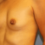 Breast Augmentation Before & After Patient #7052