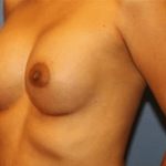 Breast Augmentation Before & After Patient #7052