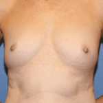 Breast Augmentation Before & After Patient #7049