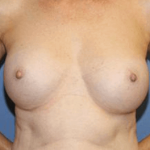 Breast Augmentation Before & After Patient #7049