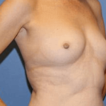 Breast Augmentation Before & After Patient #7050