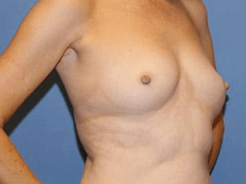 Breast Augmentation Before & After Patient #7050