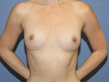 Breast Augmentation Before & After Patient #7133