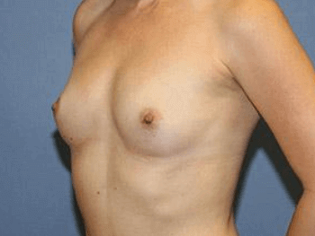 Breast Augmentation Before & After Patient #7051