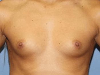 Breast Augmentation Before & After Patient #7047
