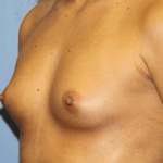 Breast Augmentation Before & After Patient #7046