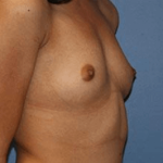 Breast Augmentation Before & After Patient #7034