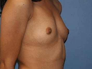 Breast Augmentation Before & After Patient #7036