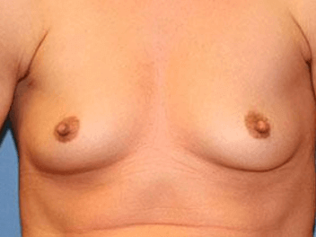 Breast Augmentation Before & After Patient #7033