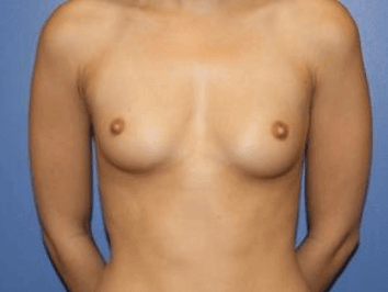 Breast Augmentation Before & After Patient #7004