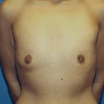 Breast Augmentation Before & After Patient #7002