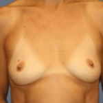 Breast Augmentation Before & After Patient #7001