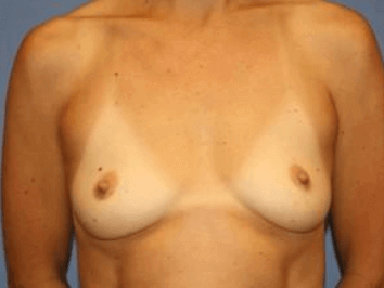 Breast Augmentation Before & After Patient #7001