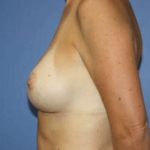 Breast Augmentation Before & After Patient #7000