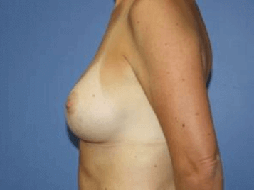 Breast Augmentation Before & After Patient #7000