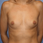 Breast Augmentation Before & After Patient #6998