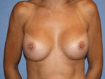 Breast Augmentation Before & After Patient #6998