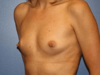 Breast Augmentation Before & After Patient #6934
