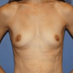 Breast Augmentation Before & After Patient #7305