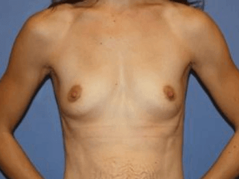 Breast Augmentation Before & After Patient #7305