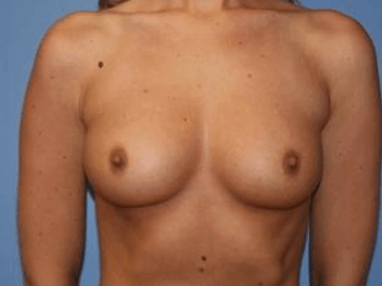 Breast Augmentation Before & After Patient #7298