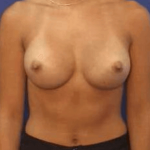 Breast Augmentation Before & After Patient #7259