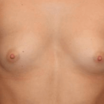 Breast Augmentation Before & After Patient #7260